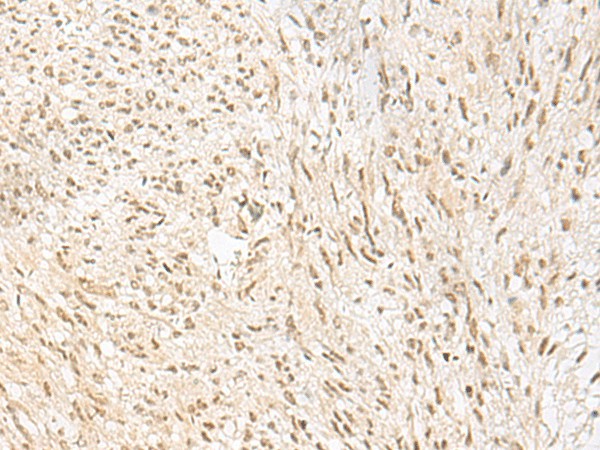 Immunohistochemistry of paraffin-embedded Human liver cancer tissue  using PSPC1 Polyclonal Antibody at dilution of 1:30(?200)