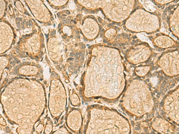 Immunohistochemistry of paraffin-embedded Human thyroid cancer tissue  using HORMAD2 Polyclonal Antibody at dilution of 1:45(?200)