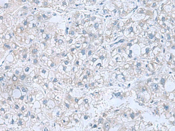 Immunohistochemistry of paraffin-embedded Human liver cancer tissue  using ATP6V1C1 Polyclonal Antibody at dilution of 1:100(?200)