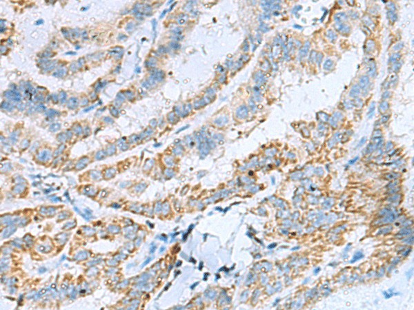 Immunohistochemistry of paraffin-embedded Human thyroid cancer tissue  using KIF5A Polyclonal Antibody at dilution of 1:30(?200)