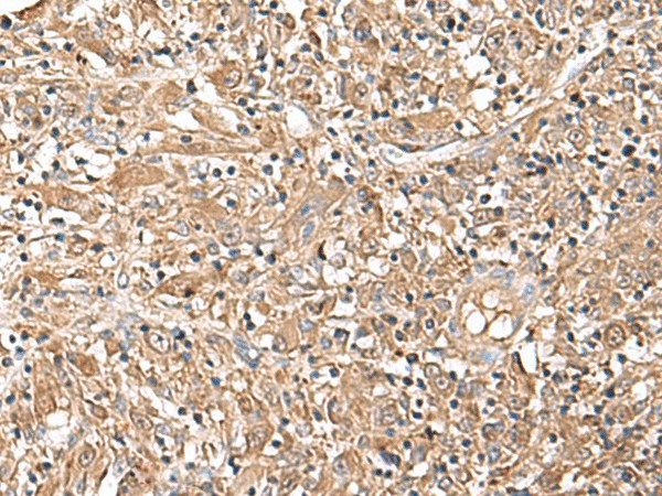 Immunohistochemistry of paraffin-embedded Human liver cancer tissue  using LEPR Polyclonal Antibody at dilution of 1:30(?200)