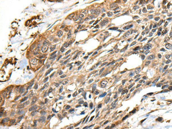 Immunohistochemistry of paraffin-embedded Human esophagus cancer tissue  using CCDC113 Polyclonal Antibody at dilution of 1:35(?200)