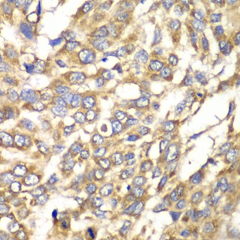 Immunohistochemistry of paraffin-embedded human esophageal cancer using VTI1B Polyclonal antibody at dilution of 1:100 (40x lens).Perform microwave antigen retrieval with 10 mM PBS buffer pH 7.2 before commencing with IHC staining protocol.