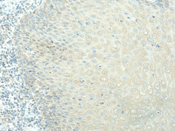 Immunohistochemistry of paraffin-embedded Human esophagus cancer tissue  using EVI2B Polyclonal Antibody at dilution of 1:40(?200)