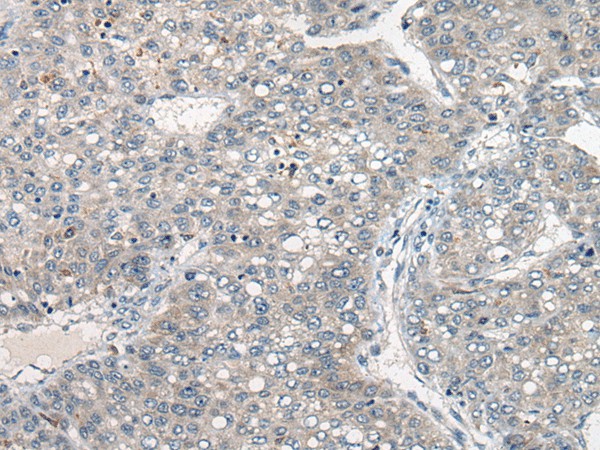 Immunohistochemistry of paraffin-embedded Human liver cancer tissue  using DGKI Polyclonal Antibody at dilution of 1:80(?200)