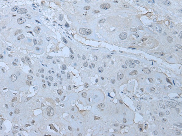 Immunohistochemistry of paraffin-embedded Human esophagus cancer tissue  using HUWE1 Polyclonal Antibody at dilution of 1:30(?200)