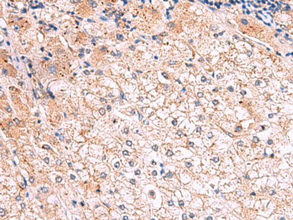 Immunohistochemistry of paraffin-embedded Human liver cancer tissue  using KLK9 Polyclonal Antibody at dilution of 1:50(?200)