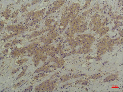 Immunohistochemistry of paraffin-embedded Human breast carcinoma tissue using ERK 1/2 Monoclonal Antibody at dilution of 1:200.