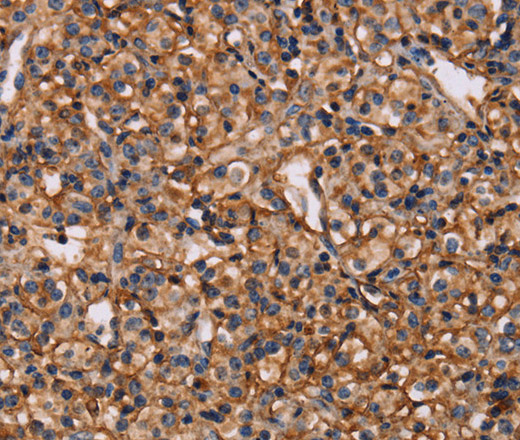 Immunohistochemistry of paraffin-embedded Human prostate cancer tissue using MAP1LC3C Polyclonal Antibody at dilution 1:40