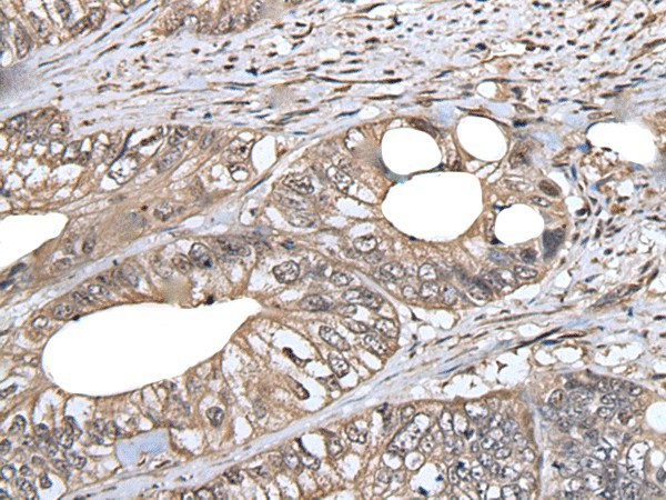 Immunohistochemistry of paraffin-embedded Human colorectal cancer tissue  using DLK1 Polyclonal Antibody at dilution of 1:30(?200)