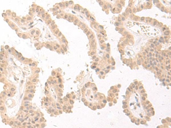 Immunohistochemistry of paraffin-embedded Human thyroid cancer tissue  using PBXIP1 Polyclonal Antibody at dilution of 1:40(?200)