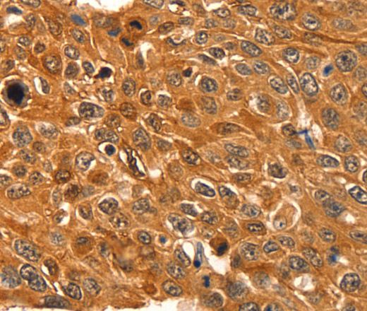 Immunohistochemistry of paraffin-embedded Human esophagus cancer using SERPINB5 Polyclonal Antibody at dilution of 1:60