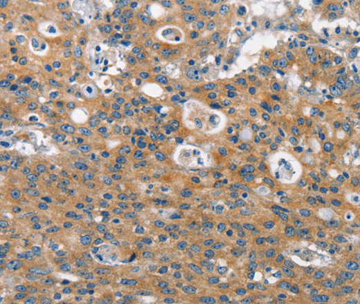 Immunohistochemistry of paraffin-embedded Human gastric cancer using CLTC Polyclonal Antibody at dilution of 1:60