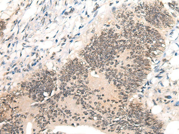 Immunohistochemistry of paraffin-embedded Human colorectal cancer tissue  using AURKA Polyclonal Antibody at dilution of 1:40(?200)