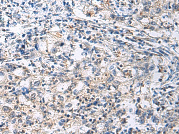 Immunohistochemistry of paraffin-embedded Human gastric cancer tissue  using SLC30A3 Polyclonal Antibody at dilution of 1:70(?200)