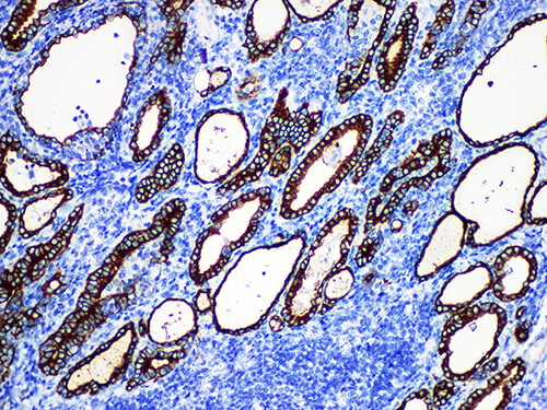 Immunohistochemistry of paraffinembedded Human thyroid tissue with Thyroid Peroxidase(TPO) Monoclonal Antibody(Antigen repaired by EDTA).