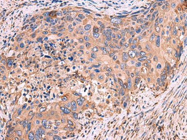 Immunohistochemistry of paraffin-embedded Human cervical cancer tissue  using GUSB Polyclonal Antibody at dilution of 1:50(?200)