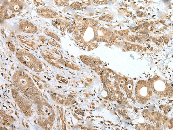 Immunohistochemistry of paraffin-embedded Human gastric cancer tissue  using SPCS2 Polyclonal Antibody at dilution of 1:35(?200)