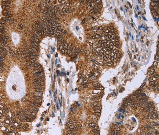 Immunohistochemistry of paraffin-embedded Human colon cancer tissue using ERCC6L Polyclonal Antibody at dilution 1:30