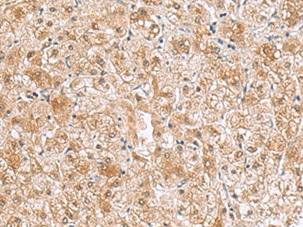 Immunohistochemistry of paraffin-embedded Human liver cancer tissue  using RTKN2 Polyclonal Antibody at dilution of 1:70(?200)