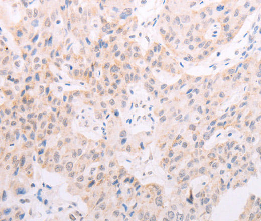 Immunohistochemistry of paraffin-embedded Human lung cancer using TYR Polyclonal Antibody at dilution of 1:30