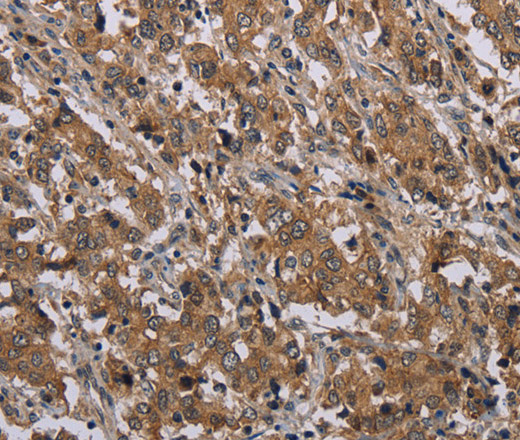 Immunohistochemistry of paraffin-embedded Human liver cancer tissue using MAL Polyclonal Antibody at dilution 1:30