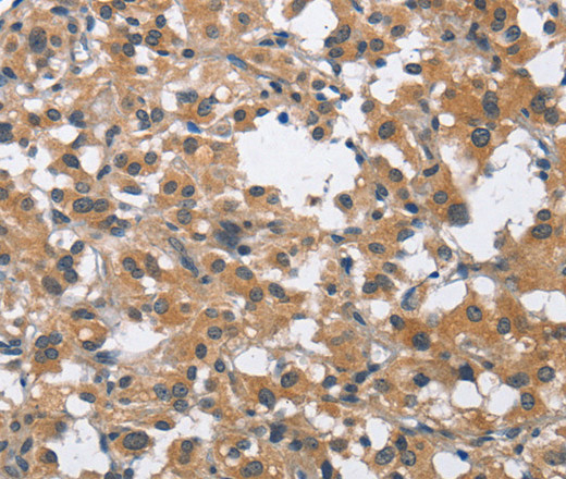 Immunohistochemistry of paraffin-embedded Human thyroid cancer tissue using BUB1 Polyclonal Antibody at dilution 1:60