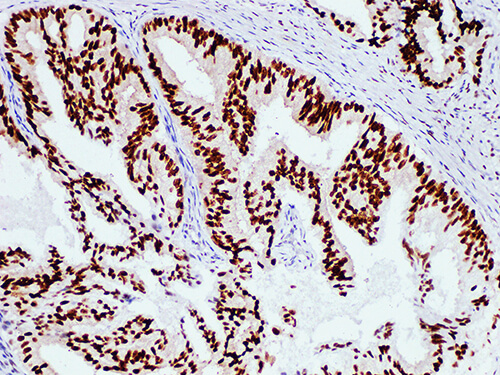 Immunohistochemistry of paraffinembedded Human prostate cancer tissue with Androgen Receptor(AR) Monoclonal Antibody(Antigen repaired by EDTA).