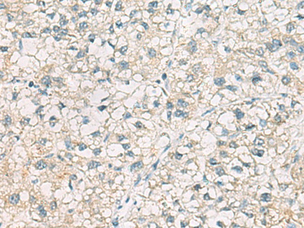 Immunohistochemistry of paraffin-embedded Human liver cancer tissue  using CHMP6 Polyclonal Antibody at dilution of 1:65(?200)