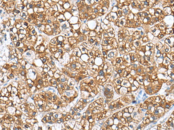 Immunohistochemistry of paraffin-embedded Human liver cancer tissue  using PHLDA3 Polyclonal Antibody at dilution of 1:110(?200)