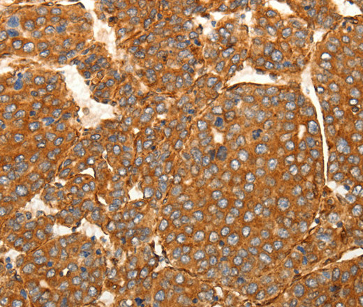 Immunohistochemistry of paraffin-embedded Human liver cancer tissue using SFRP1 Polyclonal Antibody at dilution 1:80