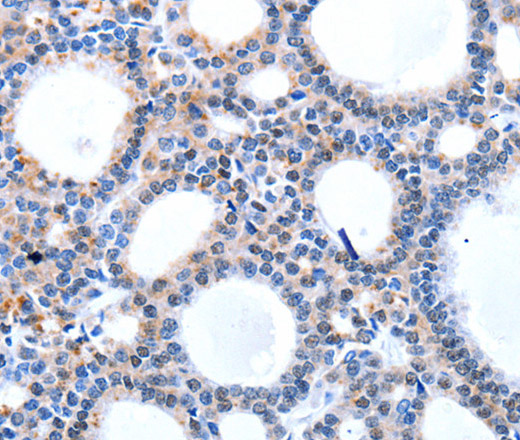 Immunohistochemistry of paraffin-embedded Human thyroid cancer using HCN1 Polyclonal Antibody at dilution of 1:50