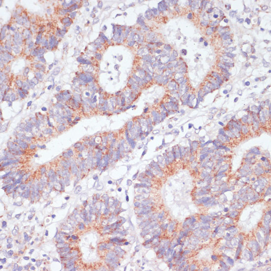 Immunohistochemistry of paraffin-embedded Human colon carcinoma using RAP1A Polyclonal Antibody at dilution of 1:100 (40x lens).