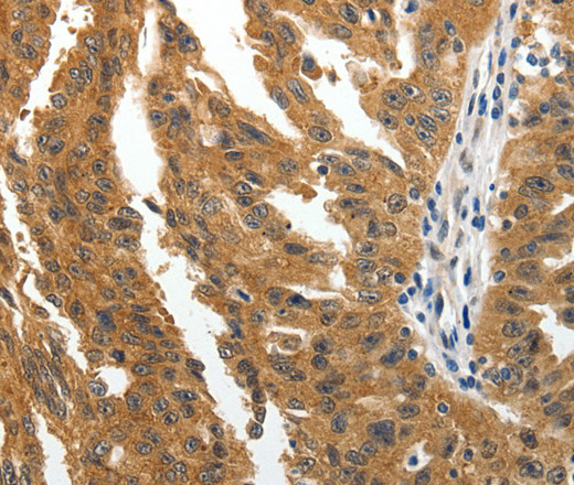 Immunohistochemistry of paraffin-embedded Human ovarian cancer tissue using BIRC6 Polyclonal Antibody at dilution 1:30