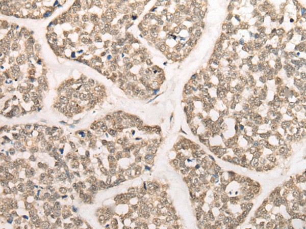 Immunohistochemistry of paraffin-embedded Human esophagus cancer tissue  using CAPN15 Polyclonal Antibody at dilution of 1:50(?200)