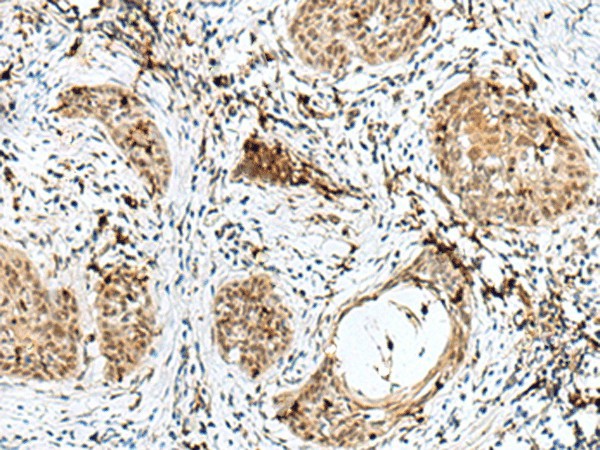 Immunohistochemistry of paraffin-embedded Human esophagus cancer tissue  using RBM15 Polyclonal Antibody at dilution of 1:50(?200)