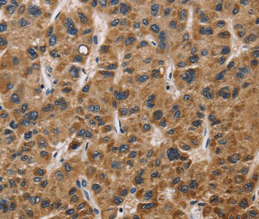 Immunohistochemistry of paraffin-embedded Human liver cancer tissue using IL19 Polyclonal Antibody at dilution 1:40