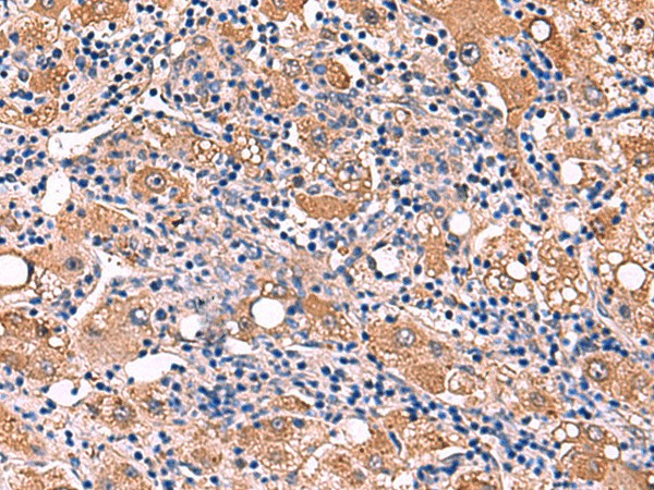 Immunohistochemistry of paraffin-embedded Human liver cancer tissue  using FDXR Polyclonal Antibody at dilution of 1:110(?200)