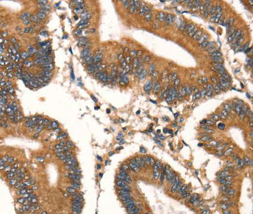 Immunohistochemistry of paraffin-embedded Human colon cancer tissue using DAP Polyclonal Antibody at dilution 1:40