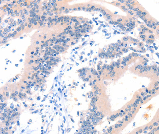 Immunohistochemistry of paraffin-embedded Human colon cancer tissue using ITGA6 Polyclonal Antibody at dilution 1:50