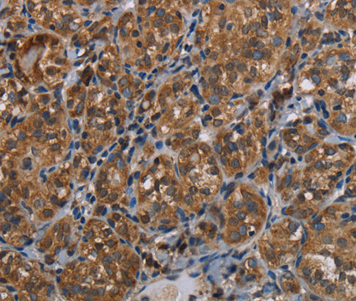 Immunohistochemistry of paraffin-embedded Human thyroid cancer tissue using LLGL1 Polyclonal Antibody at dilution 1:40