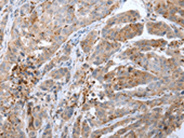 Immunohistochemistry of paraffin-embedded Human breast cancer tissue  using CALB2 Polyclonal Antibody at dilution of 1:25(?200)