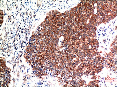 Immunohistochemistry of paraffin-embedded Human breast carcinoma tissue using BECN1 Monoclonal Antibody at dilution of 1:200.