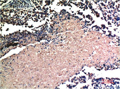 Immunohistochemistry of paraffin-embedded Human lung carcinoma tissue using AKT1 Monoclonal Antibody at dilution of 1:200.