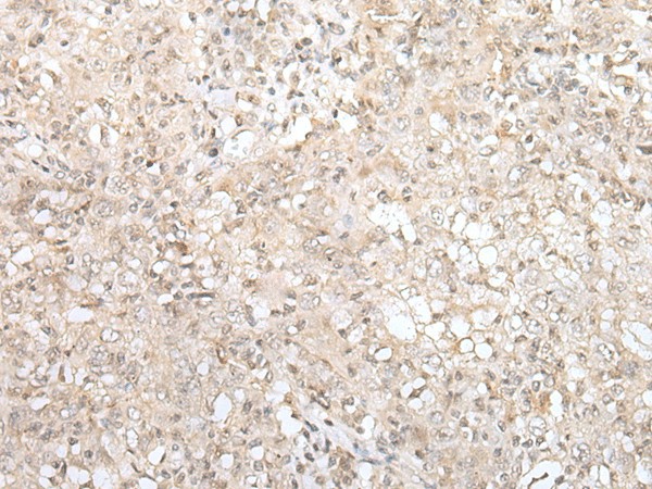 Immunohistochemistry of paraffin-embedded Human esophagus cancer tissue  using ZNF263 Polyclonal Antibody at dilution of 1:40(?200)