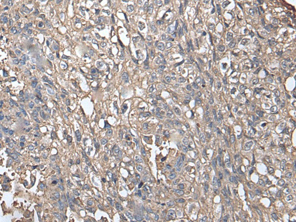 Immunohistochemistry of paraffin-embedded Human lung cancer tissue  using NDUFB5 Polyclonal Antibody at dilution of 1:45(?200)