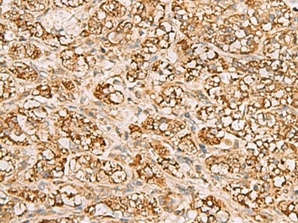 Immunohistochemistry of paraffin-embedded Human liver cancer tissue  using MTAP Polyclonal Antibody at dilution of 1:70(?200)