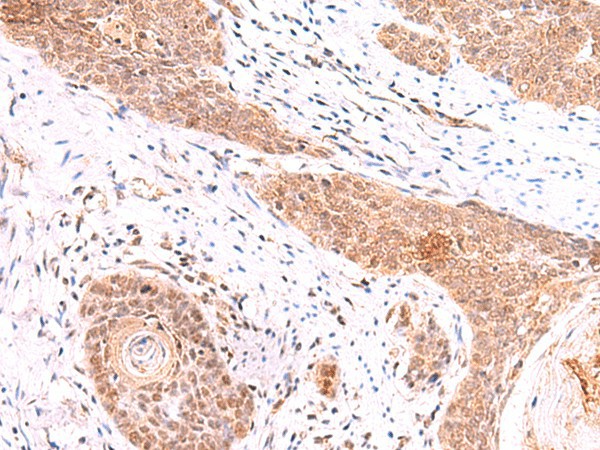 Immunohistochemistry of paraffin-embedded Human esophagus cancer tissue  using COPS3 Polyclonal Antibody at dilution of 1:60(?200)