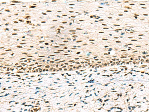 Immunohistochemistry of paraffin-embedded Human cervical cancer tissue  using ABI2 Polyclonal Antibody at dilution of 1:45(?200)