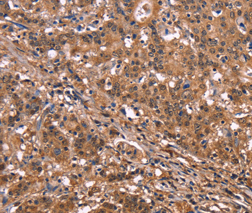 Immunohistochemistry of paraffin-embedded Human liver cancer tissue using NOS2 Polyclonal Antibody at dilution 1:40